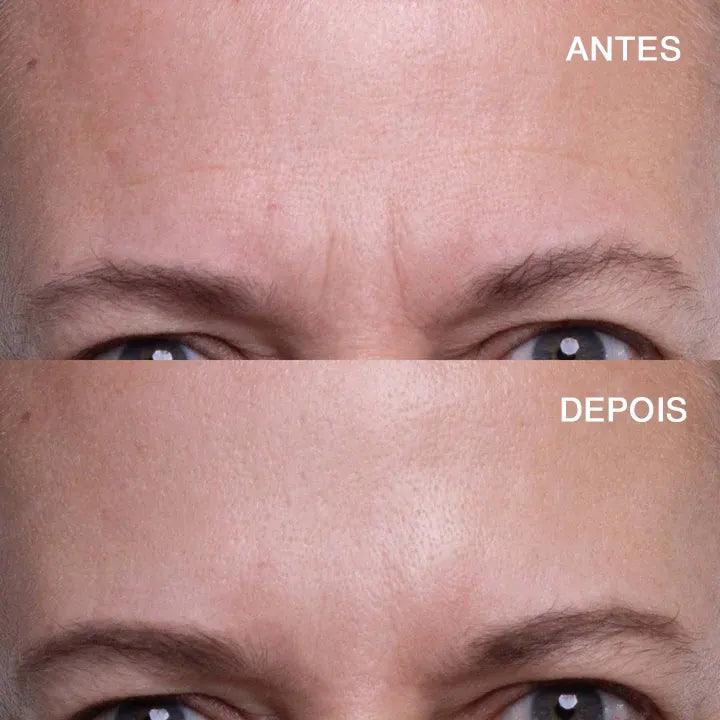 Adesivo antirrugas para testa