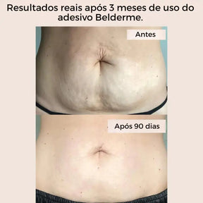 Adesivos corporais reutilizáveis para estrias e celulite