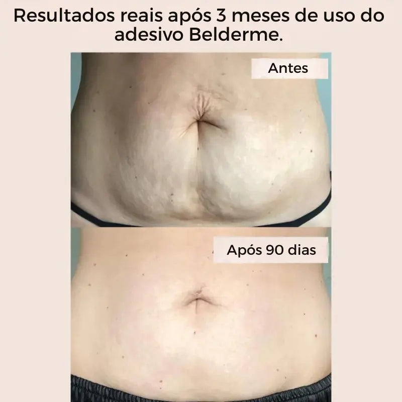 Adesivos corporais reutilizáveis para estrias e celulite